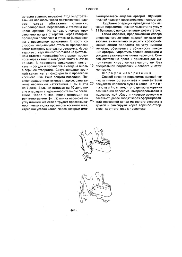 Способ лечения переломов нижней челюсти (патент 1799550)