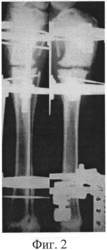 Способ моделирования дефект-псевдоартроза кости конечности (патент 2539627)