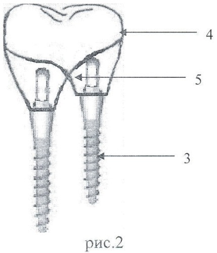 Способ временного протезирования зубов в период остеоинтеграции двухэтапных дентальных имплантатов (патент 2454967)