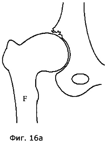 Устройство и способ для лечения бедренно-вертлужного соударения (патент 2506928)