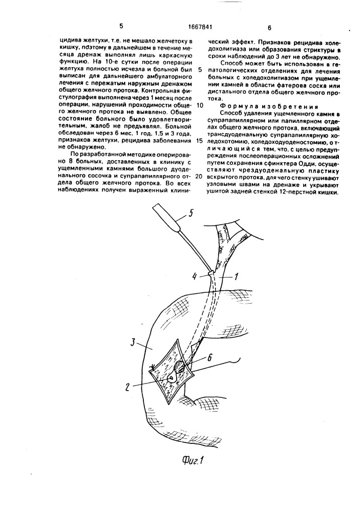 Способ удаления ущемленного камня в супрапапиллярном или папиллярном отделах общего желчного протока (патент 1667841)