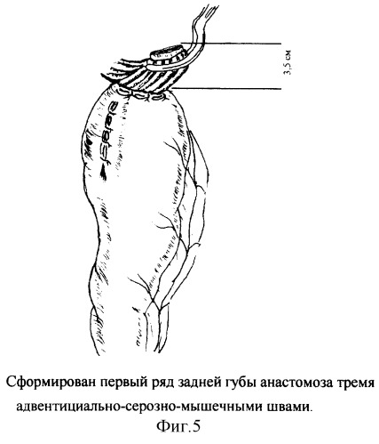 Новый способ формирования эзофагогастроанастомоза в условиях недостатка пластического материала путем модификации задней губы (патент 2248185)