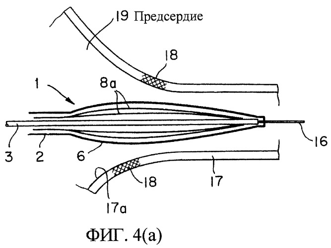 Радиочастотный термический баллонный катетер (патент 2244523)