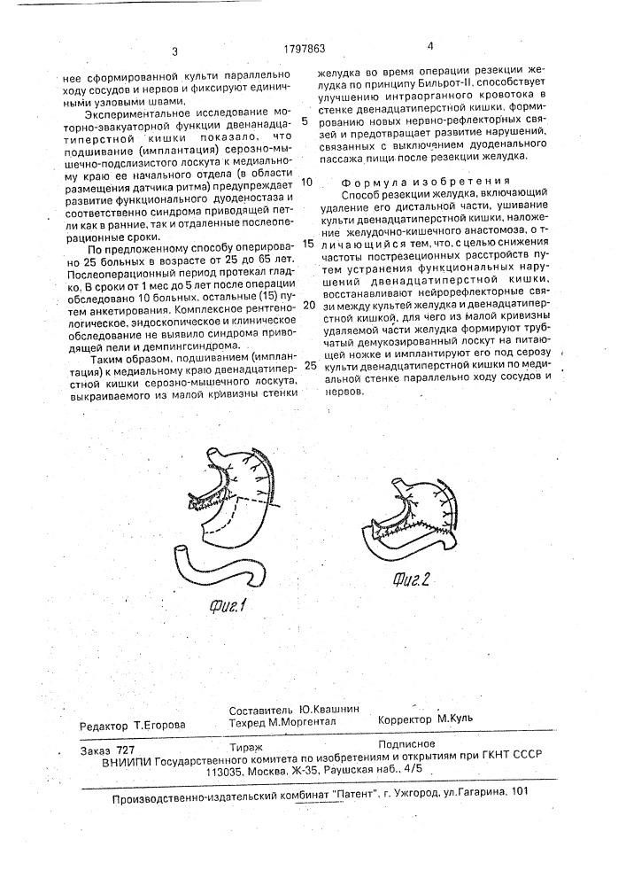 Способ резекции желудка (патент 1797863)