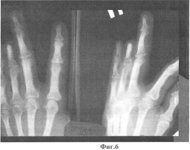 Способ кожно-костной реконструкции пальца кисти (патент 2482803)
