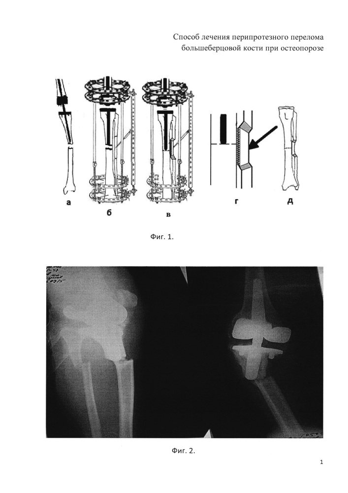 Способ лечения перипротезного перелома большеберцовой кости при остеопорозе (патент 2656766)
