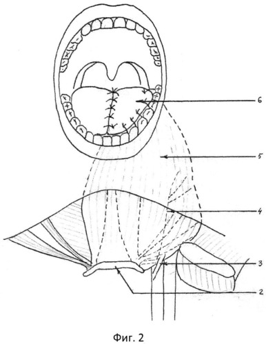 Способ реконструкции языка и дна полости рта (патент 2546097)