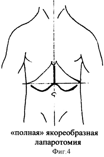 Способ поперечной лапаротомии (патент 2367362)