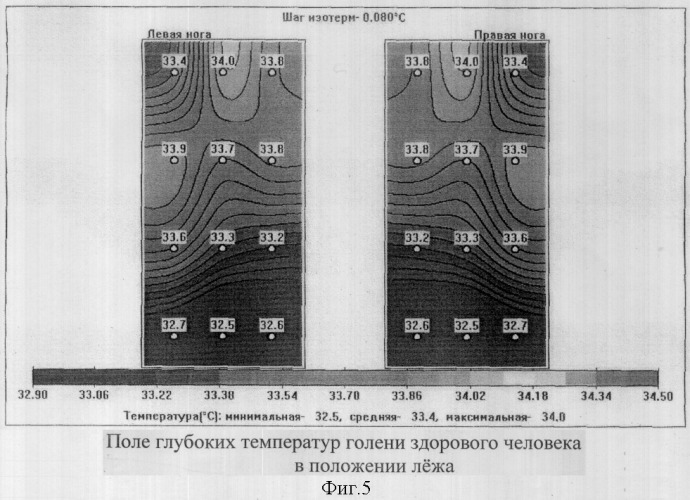 Способ комбинированной термометрии для диагностики посттромботической болезни вен нижних конечностей (патент 2319438)