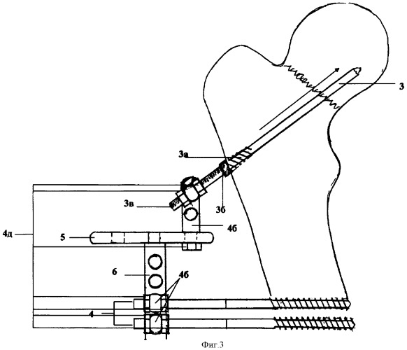 Устройство для остеосинтеза медиальных переломов шейки бедренной кости (патент 2337645)