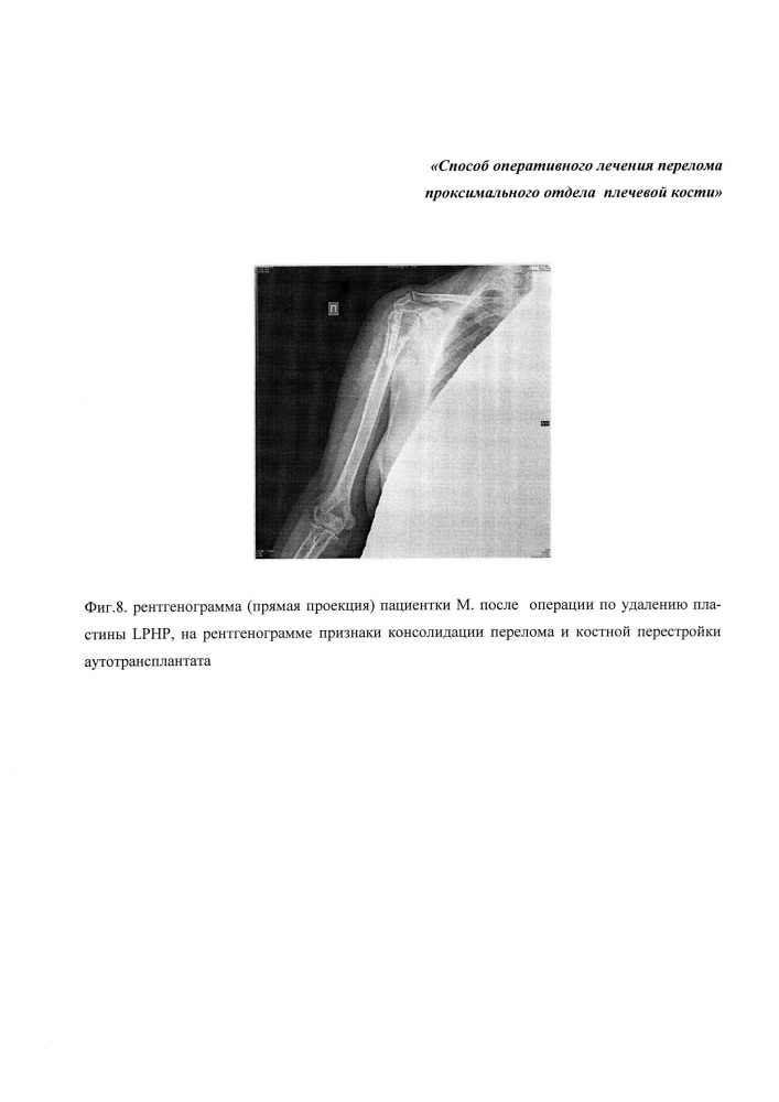Способ хирургического лечения перелома проксимального отдела плечевой кости (патент 2652573)