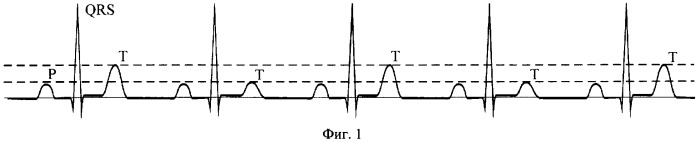 Способ выявления альтернаций т-зубца электрокардиосигнала в режиме реального времени и устройство для его осуществления (патент 2371087)