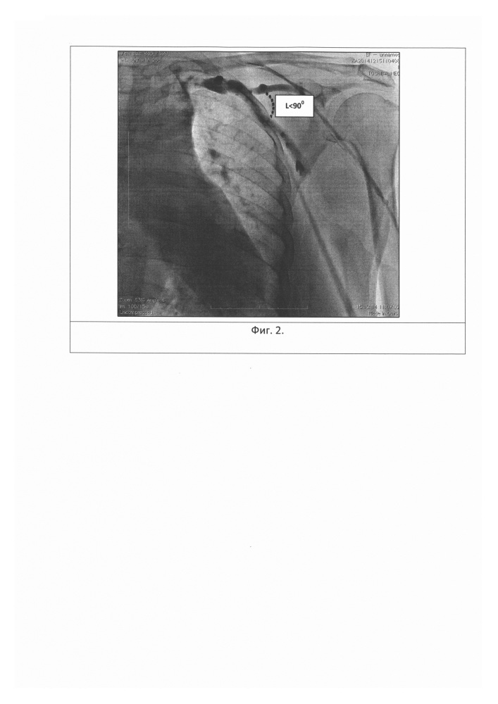 Способ выбора метода проведения эндокардиальных электродов в правые отделы сердца при имплантации антиаритмических устройств (патент 2662417)