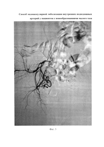 Способ эндоваскулярной эмболизации внутренних подвздошных артерий у пациенток с новообразованиями малого таза (патент 2576092)