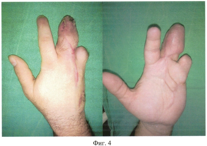 Способ пересадки пятого пястно-фалангового сустава для замещения дефекта третьего пальца кисти (патент 2556616)