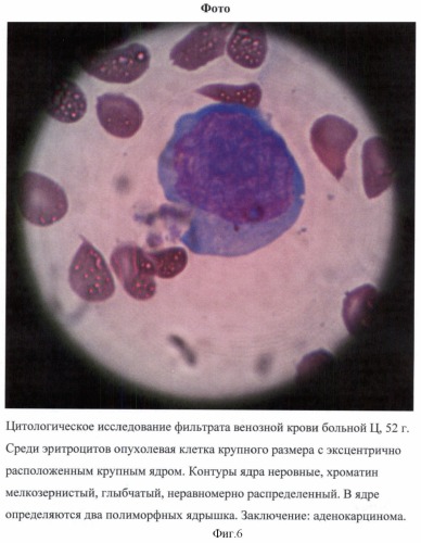 Способ определения раковых клеток в периферической венозной крови у больных с подозрением на злокачественные новообразования (патент 2425385)