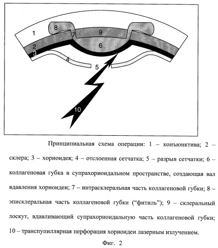 Способ лечения регматогенной отслойки сетчатки (патент 2244530)