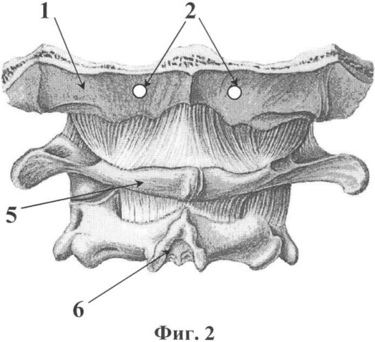 Способ фиксации шейно-затылочной области позвоночника (патент 2342915)