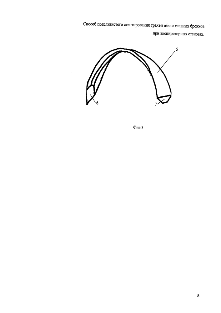 Способ подслизистого стентирования трахеи и/или главных бронхов при экспираторных стенозах (патент 2629042)