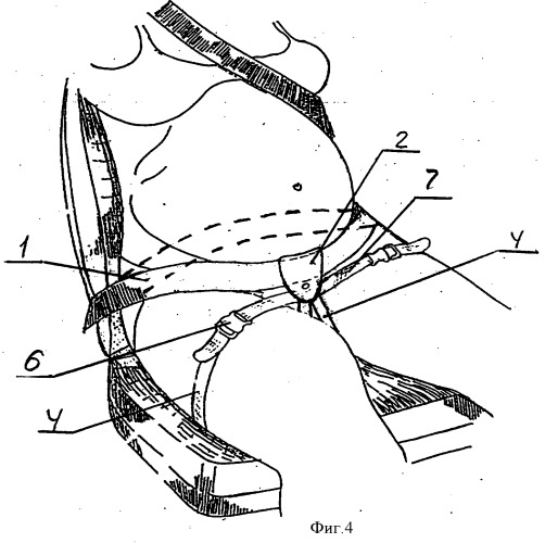 Удерживающее устройство ремня безопасности для беременных (патент 2357879)