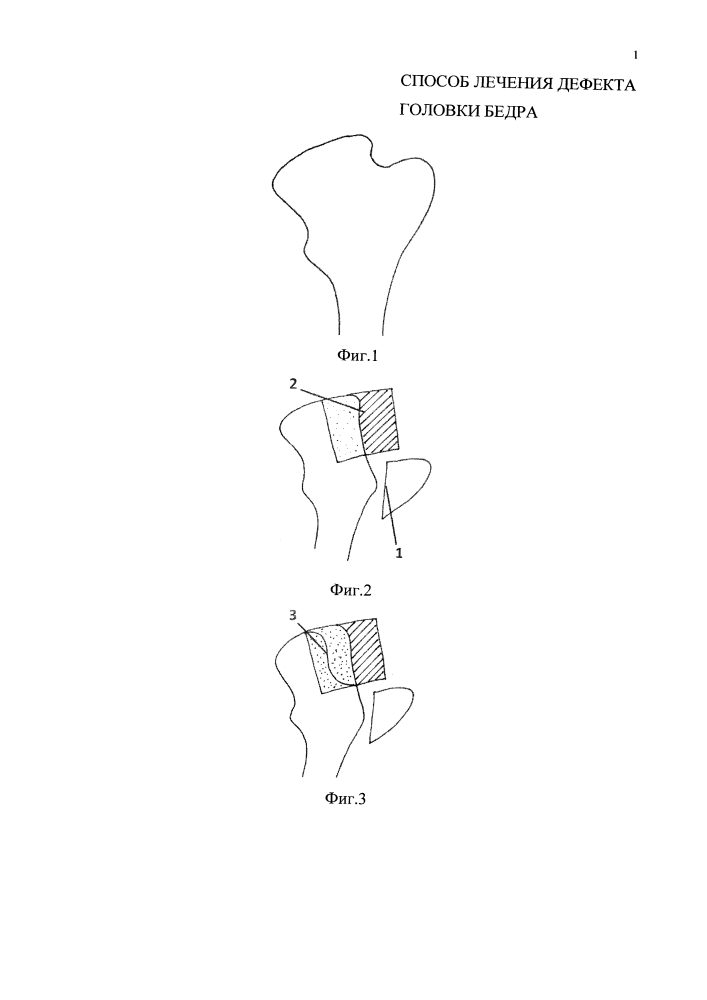Способ лечения дефекта головки бедра (патент 2637290)