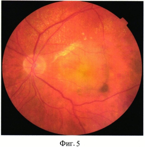 Способ лечения "влажной" формы возрастной макулярной дегенерации (патент 2541834)