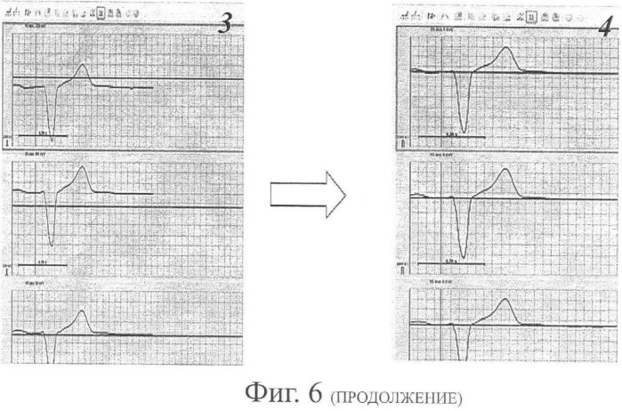 Способ неинвазивного электрофизиологического исследования сердца (патент 2417051)