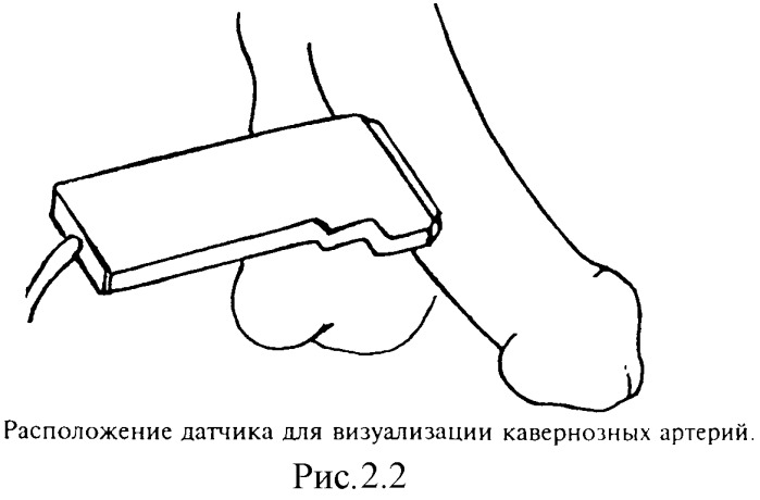 Способ диагностики васкулогенной эректильной дисфункции (патент 2336820)