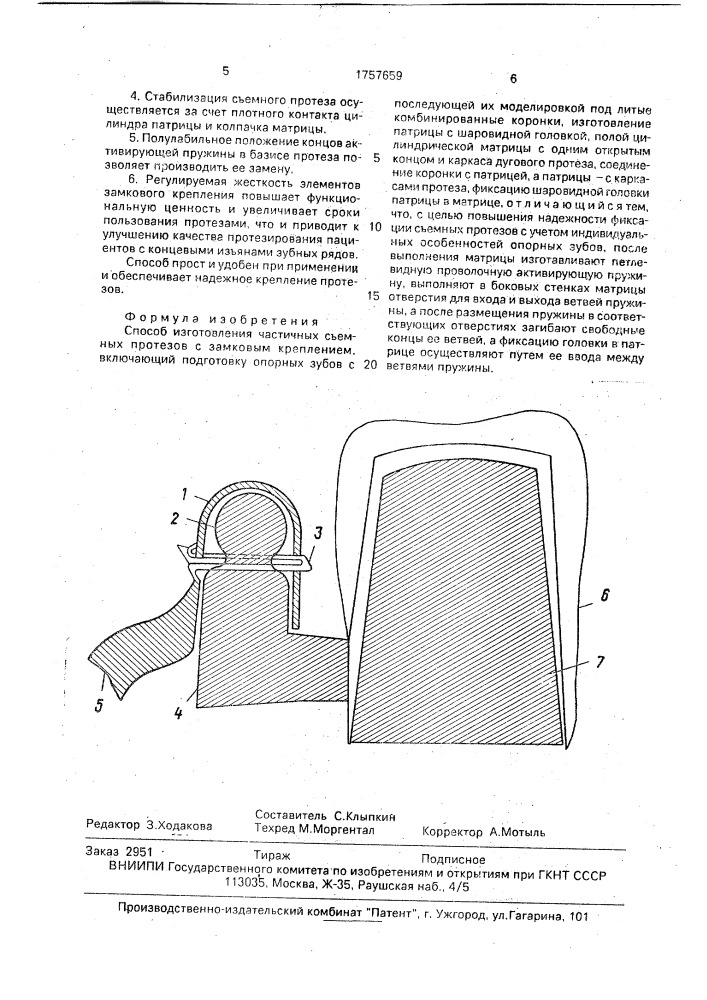 Способ изготовления частичных съемных протезов с замковым креплением (патент 1757659)