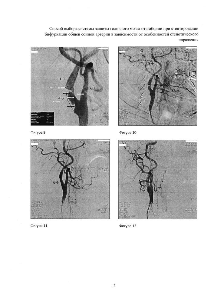 Способ выбора системы защиты головного мозга от эмболии при стентировании бифуркации общей сонной артерии в зависимости от особенностей стенотического поражения (патент 2609206)