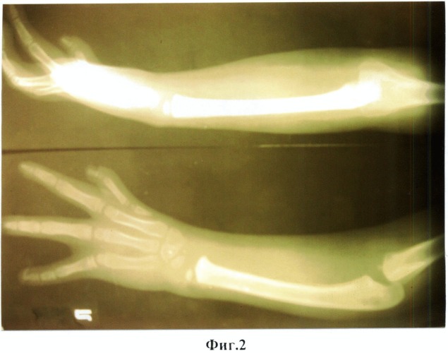 Способ лечения врожденной лучевой косорукости (патент 2521843)