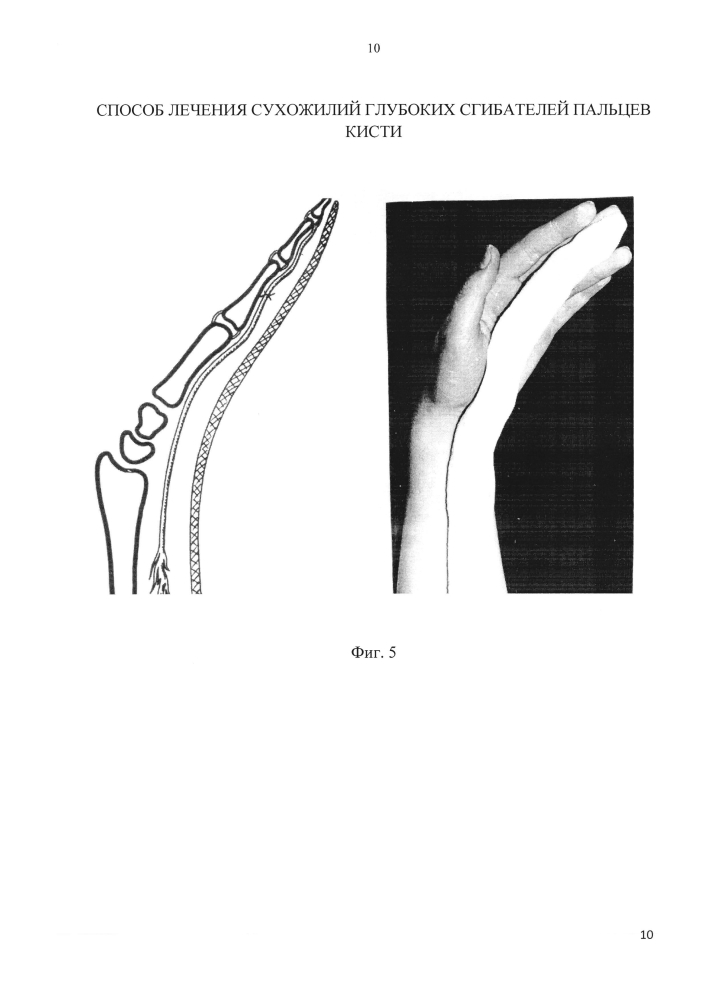 Способ лечения повреждений сухожилий глубоких сгибателей пальцев кисти (патент 2602796)
