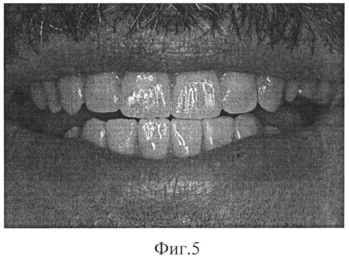 Способ эстетической реставрации зубов (патент 2529398)