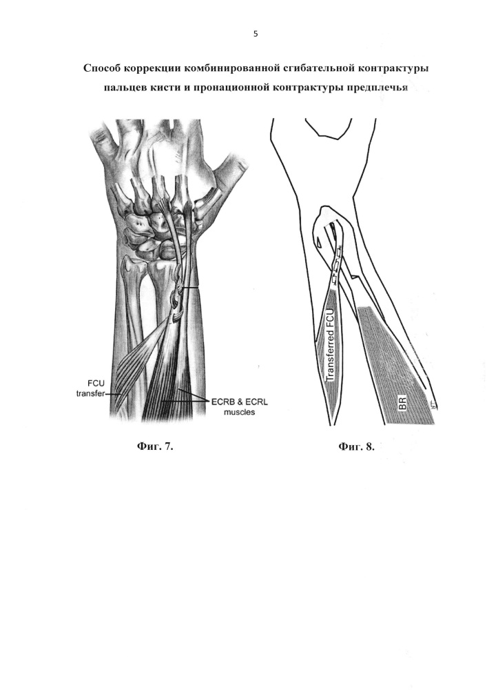 Способ коррекции комбинированной сгибательной контрактуры трехфаланговых пальцев кисти и пронационной контрактуры предплечья (патент 2627290)