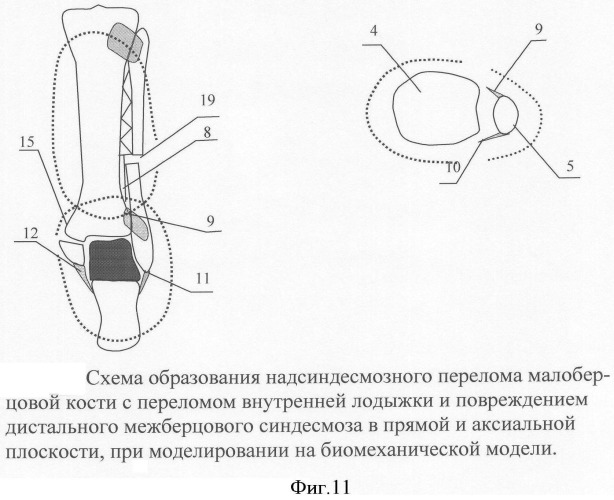 Модель системы стабилизации таранной кости при переломовывихах голеностопного сустава (патент 2340010)