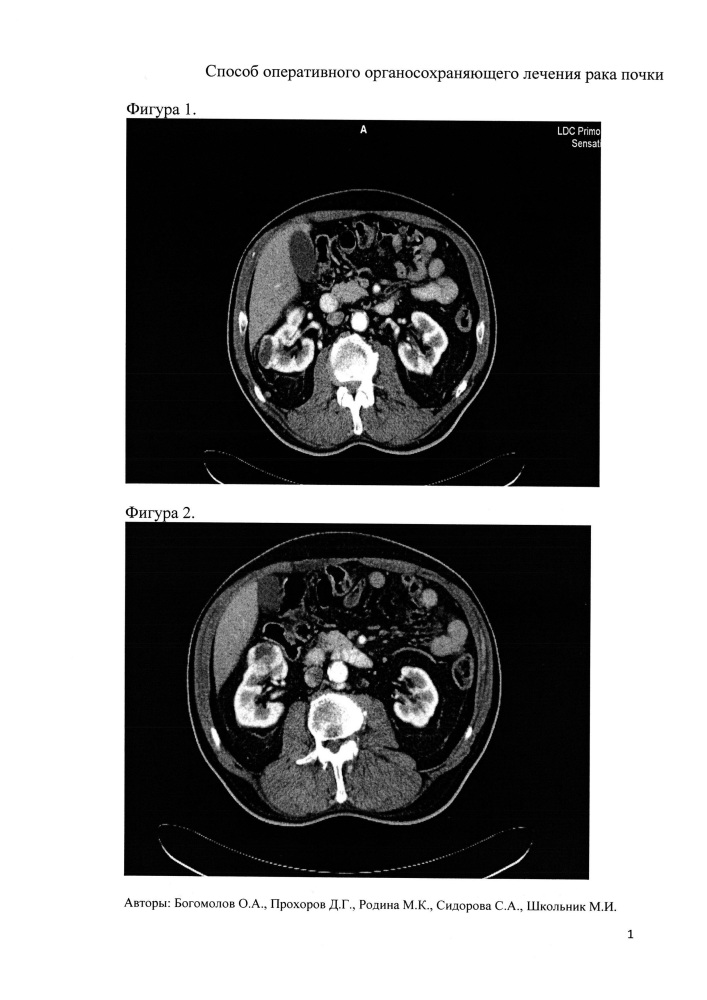 Способ оперативного органосохраняющего лечения рака почки (патент 2653910)