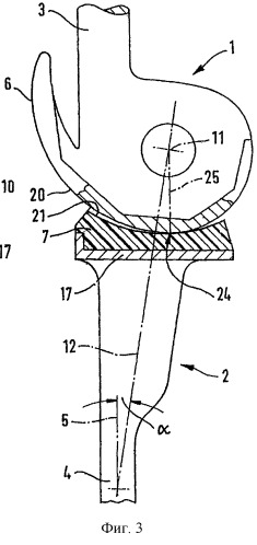 Протез коленного сустава, сопряженный с подшипником вращения (патент 2265422)