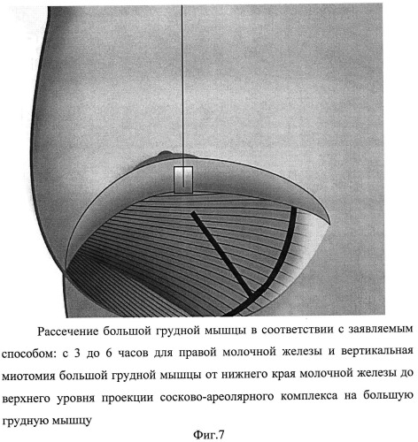 Способ формирования кармана для имплантата в двойственной плоскости при аугментационной маммопластике (патент 2498777)