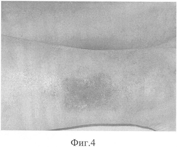Способ лечения больных с недостаточностью клапанов перфорантных вен голени, осложненной трофическими язвами (патент 2328997)