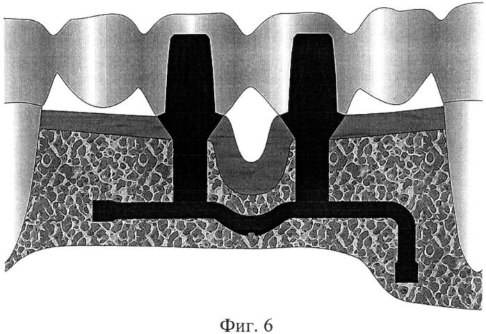 Базальный остеоинтегрированный имплантат (патент 2491032)