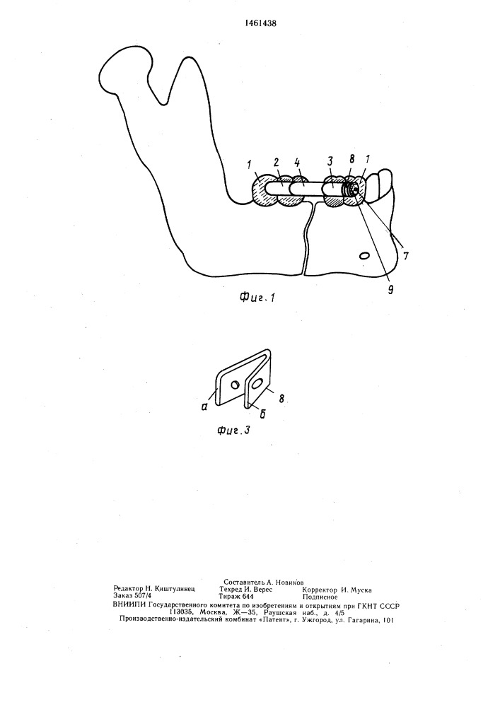 Устройство для фиксации отломков нижней челюсти (патент 1461438)