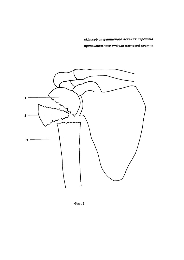 Способ хирургического лечения перелома проксимального отдела плечевой кости (патент 2652573)