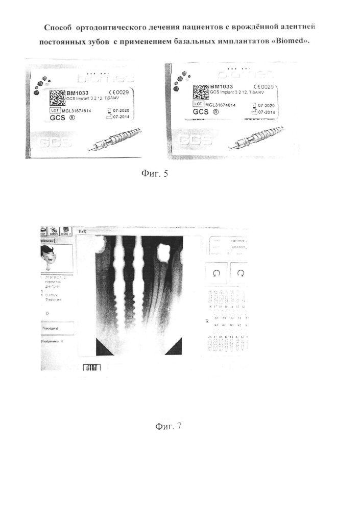 Способ ортодонтического лечения пациентов с врождённой адентией постоянных зубов с применением базальных имплантатов "biomed" (патент 2638286)