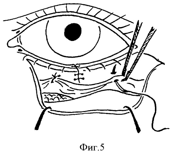 Способ устранения сенильного выворота нижнего века (патент 2380067)