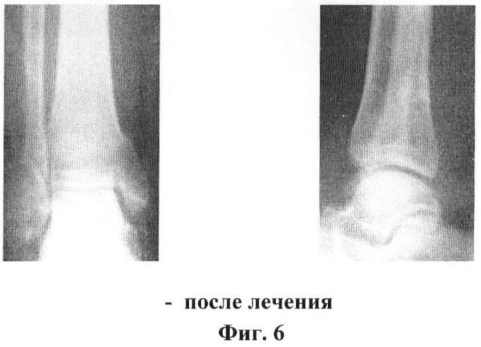Способ лечения переломовывихов в голеностопном суставе с инверсионным подвывихом таранной кости (патент 2415651)
