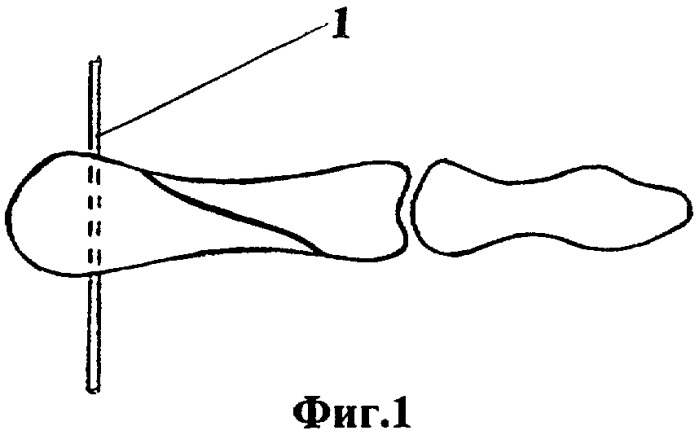 Способ фиксации отломков при переломах фаланг пальцев кисти (патент 2322210)