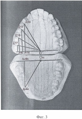 Способ биометрической ортодонтической диагностики на моделях челюстей (патент 2446739)