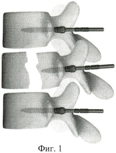 Способ лечения оскольчатого перелома тела позвонка со сдавлением дурального мешка (патент 2433797)
