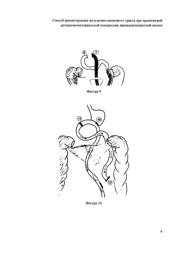 Способ реконструкции желудочно-кишечного тракта при хронической артериомезентериальной компрессии двенадцатиперстной кишки (патент 2607512)