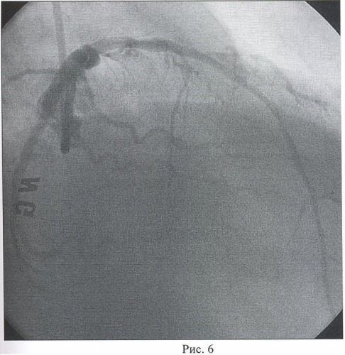 Способ коррекции окклюзии коронарной артерии (патент 2456934)